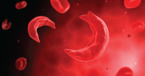 Sickle Cell Anemia