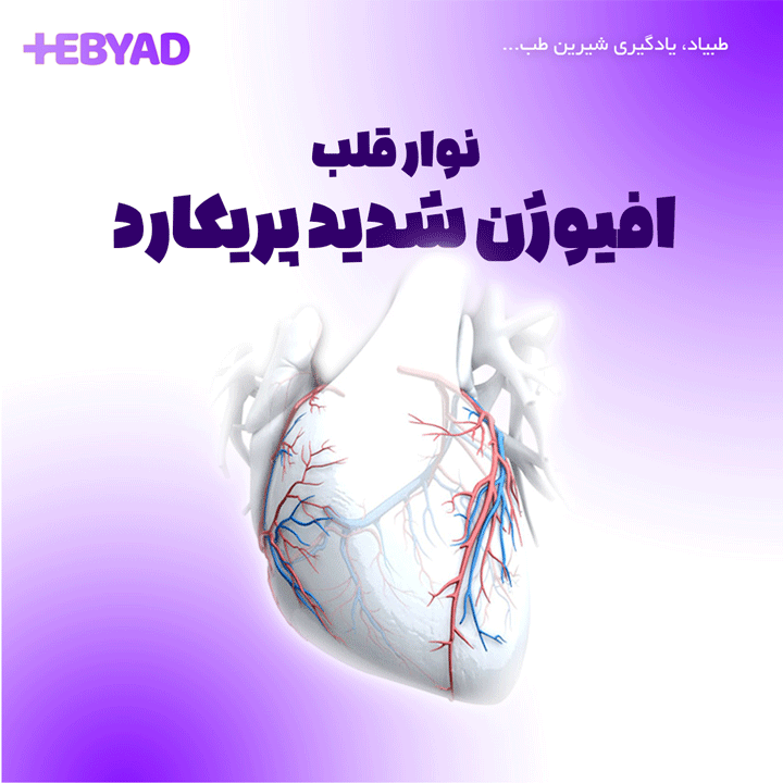 نوار قلب افیوژن شدید پریکارد